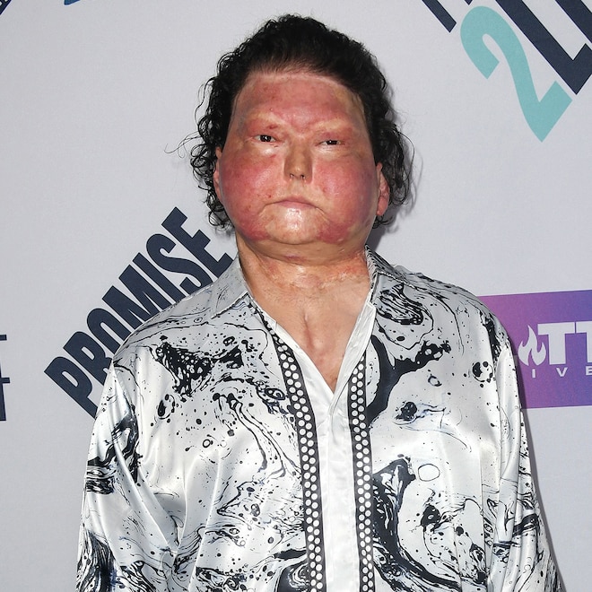 TikToker Joe DiMeo Details Face Transplant After Car Crash, Body Burns